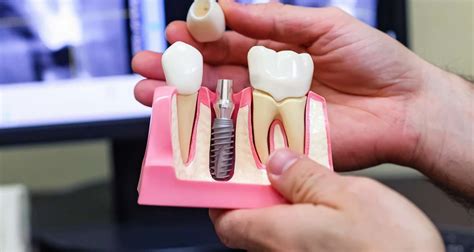 trinon implant course|best dental implant courses.